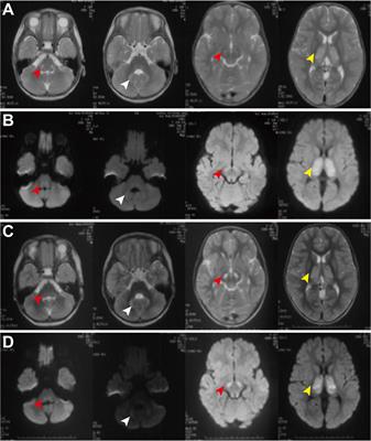 Novel Mutations in the GTPBP3 Gene for Mitochondrial Disease and Characteristics of Related Phenotypic Spectrum: The First Three Cases From China